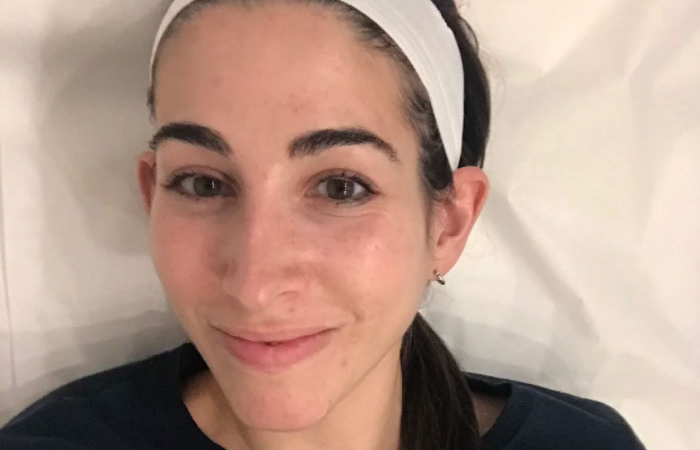 I Tried a Jet Peel Facial and Had My Skin Irrigated and My Blackheads Vacuumed Out.