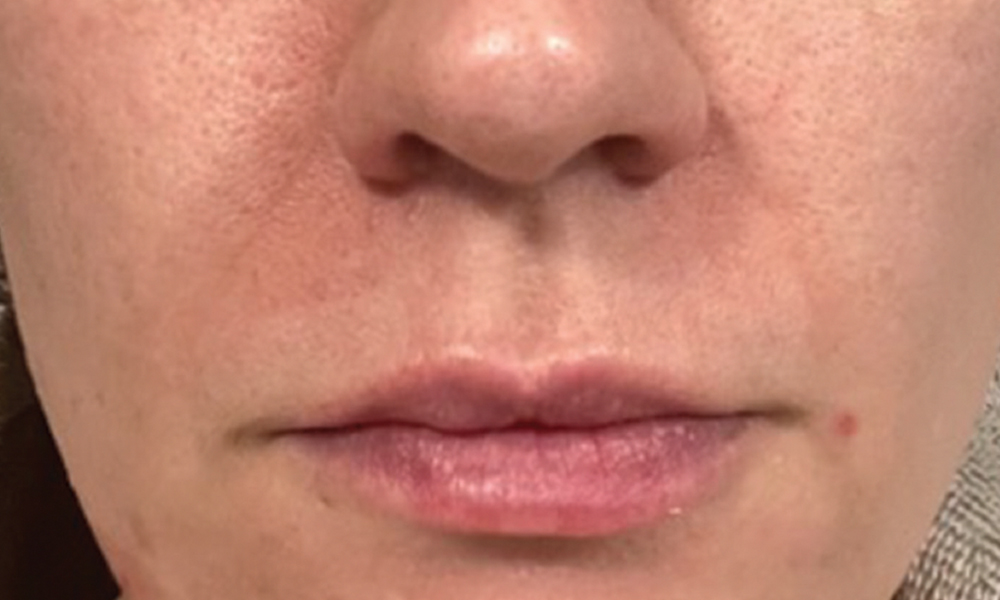 Hale Derma™ Treatment: After