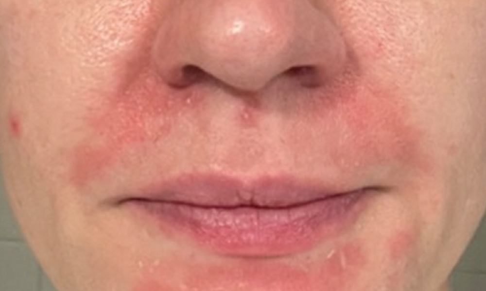 Hale Derma™ Treatment: Before