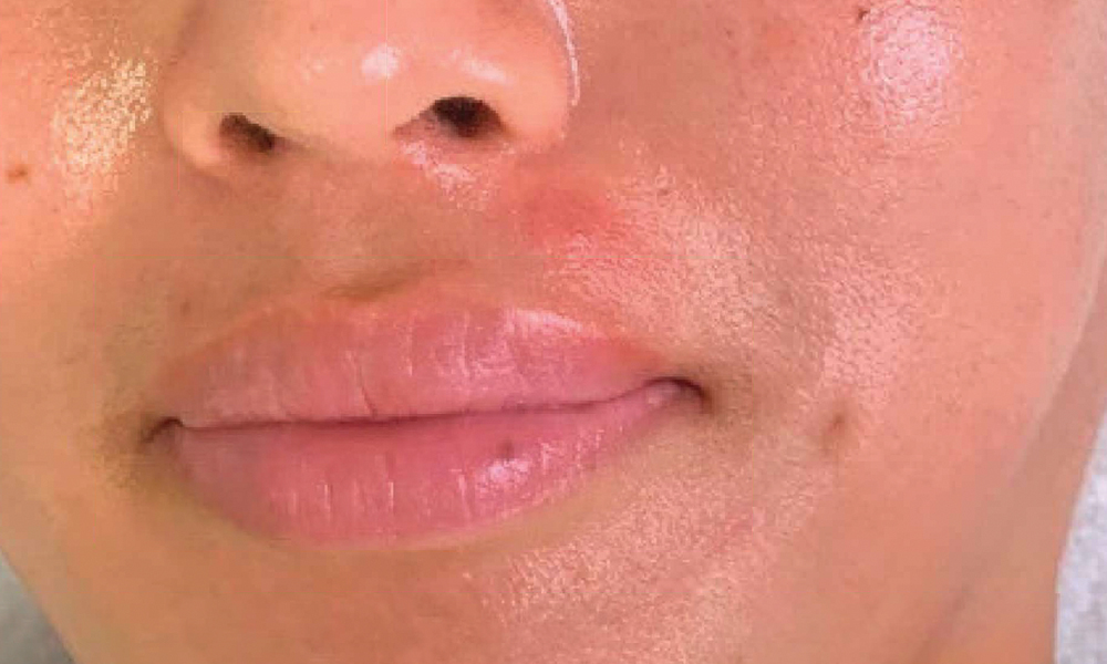 JetPeel™ Treatment: After