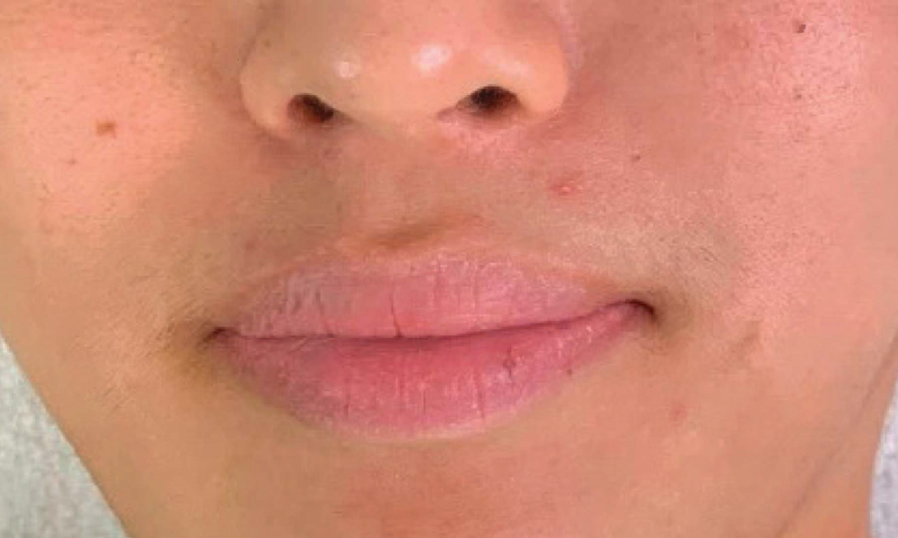 JetPeel™ Treatment: Before