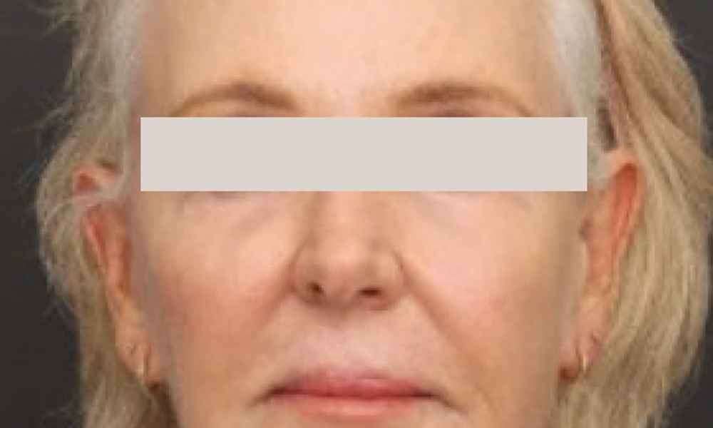 Sofwave™ Treatment: After