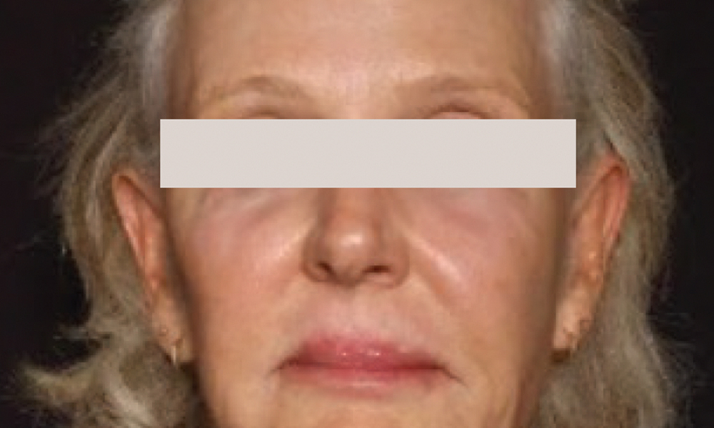 Sofwave™ Treatment: Before