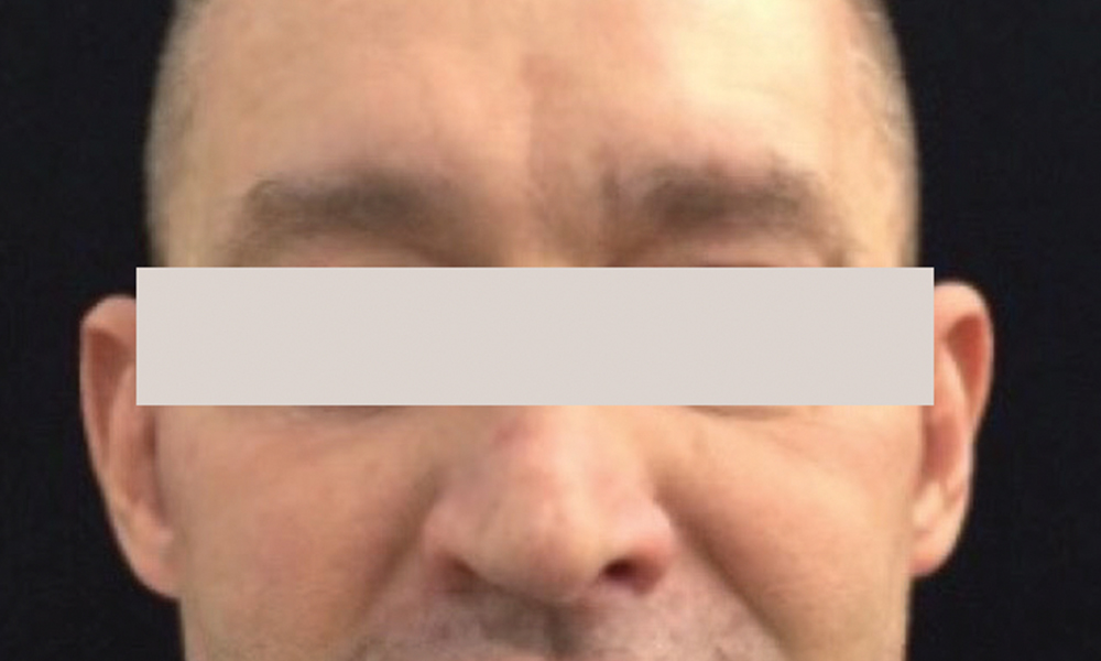 Sylfirm X Treatment: After