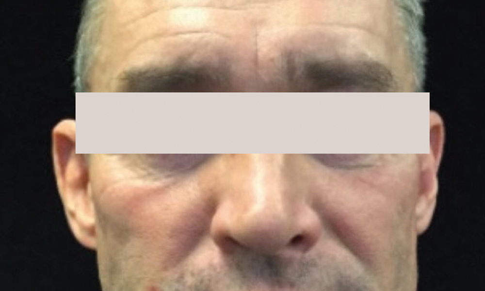 Sylfirm X Treatment: Before