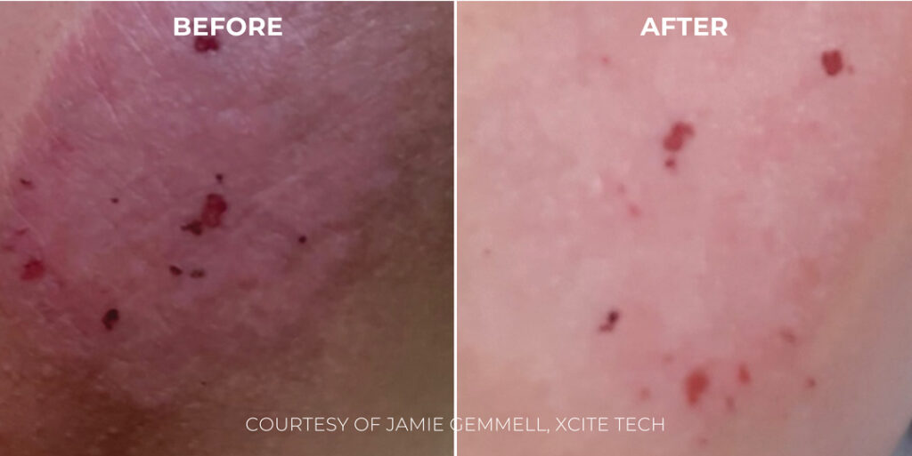 Xcite_Halederma_B&As_Artboard-1