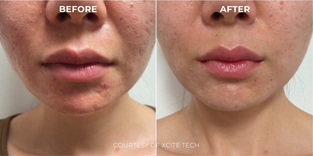 Xcite_Halederma_B&As_Artboard-3