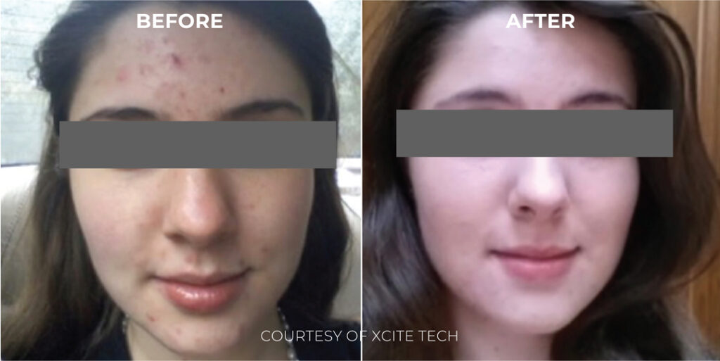 Xcite_Halederma_B&As_Artboard-4