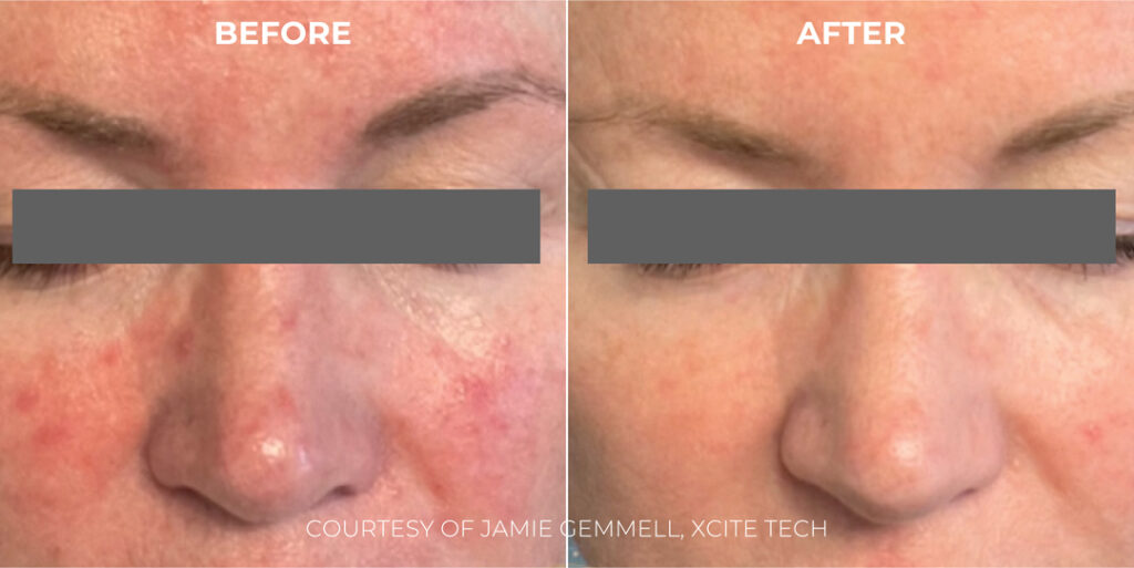 Xcite_Halederma_B&As_Artboard-7